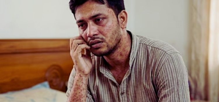 শুধু শিশু নয়, বড়দের হাম হলে কীভাবে চিনবেন ও সামলাবেন!